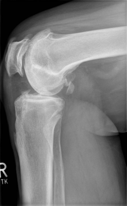 Röntgenbild vor OP von seitlich